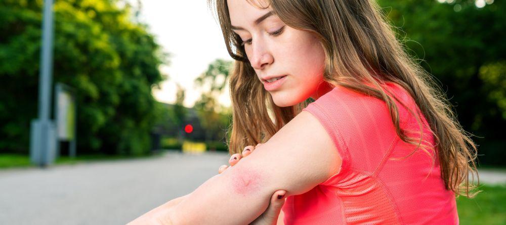 Punture di zanzara: come prevenirle e i rimedi per il prurito