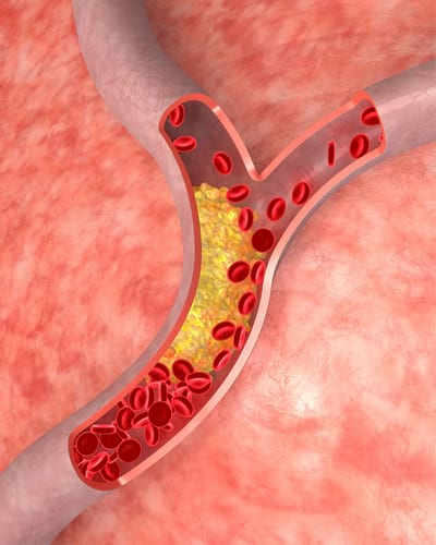 a cosa è dovuto il colesterolo alto